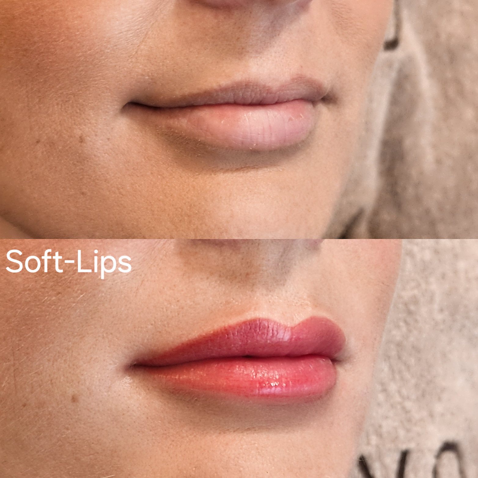 Vorher-Nachher-Effekt einer Hautbildverfeinerung